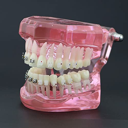 Модел на заби, стоматолошки ортодонт со метални и керамички загради за модел на студии за заби