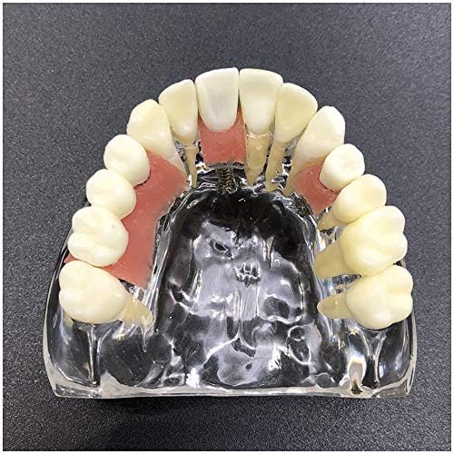 KH66ZKY максиларна студија за имплантација Анализа на демонстрација Модел на заби - модел на забна имплантација - со отстранливи